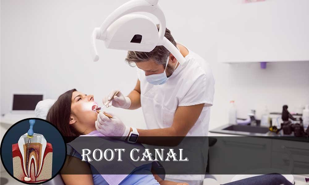 Root Canal A Helpful Guide