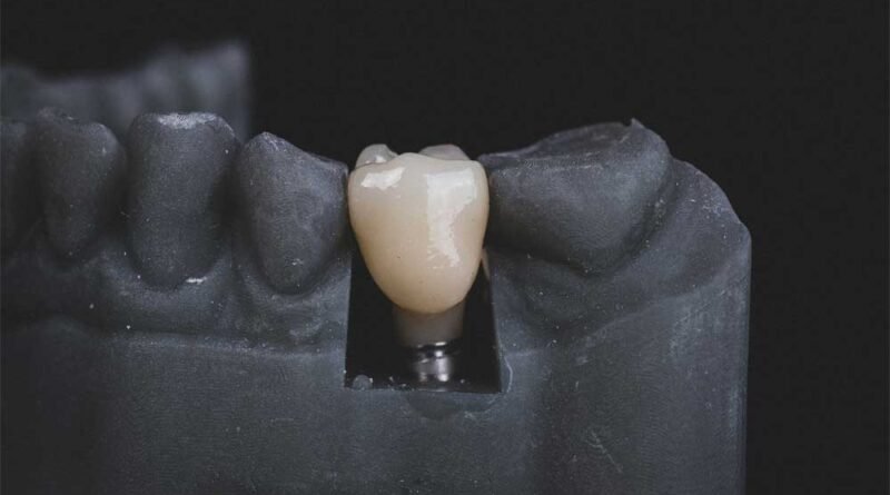4-step-dental-implant-process