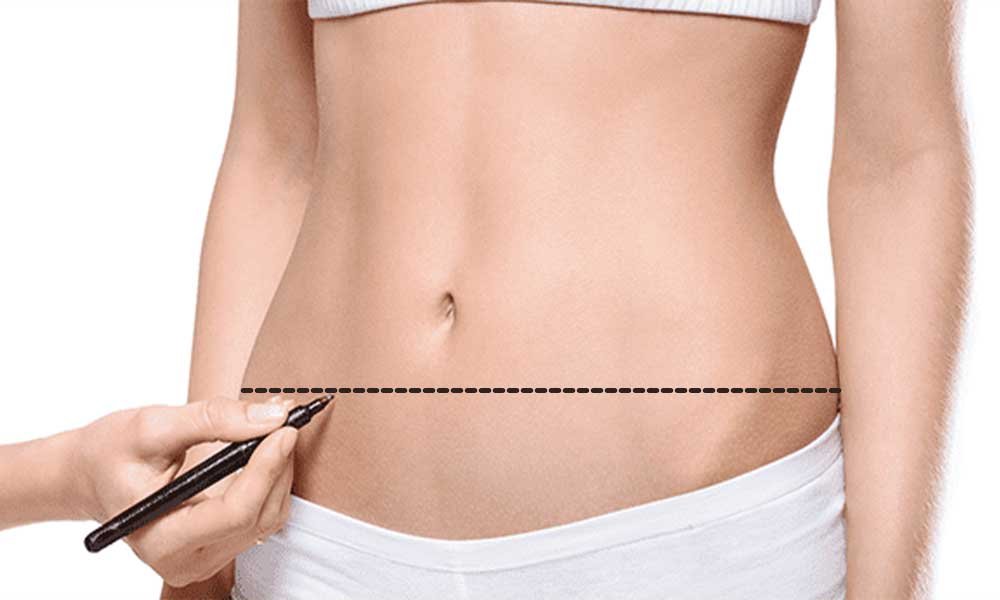 Belly fat come back after tummy tuck