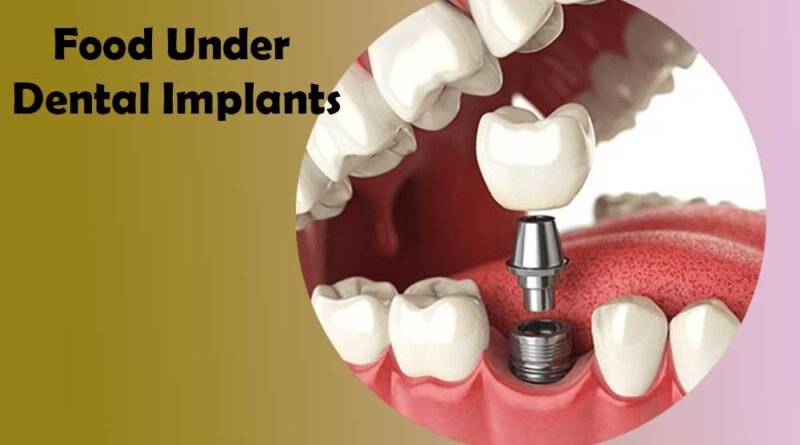 Food Under Dental Implants