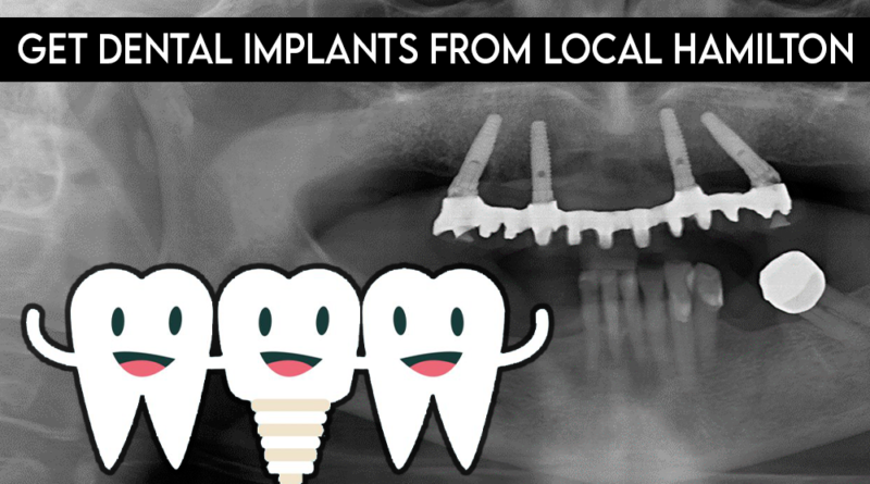 You Should Get Dental Implants from Your Local Hamilton